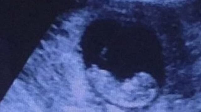 Rémület fogta el az embereket, mikor meglátták ezt az ultrahangfelvételt
