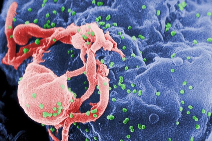 Daganatos betegségben szenved az első beteg, akit meggyógyítottak a HIV-fertőzésből