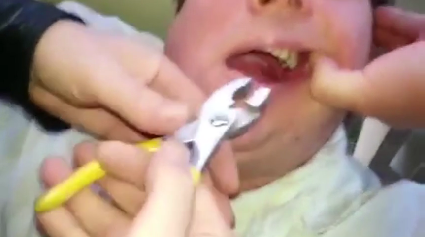 Így spórolhatunk a fogorvoson - de azért nem ajánlott kipróbálni!