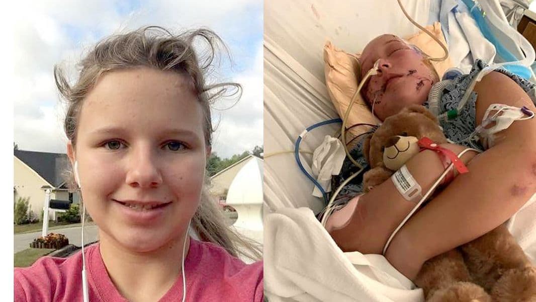 BORZALOM: Életéért küzd a tinilány, akit szabályosan megskalpolt két felbőszült pitbull 18+