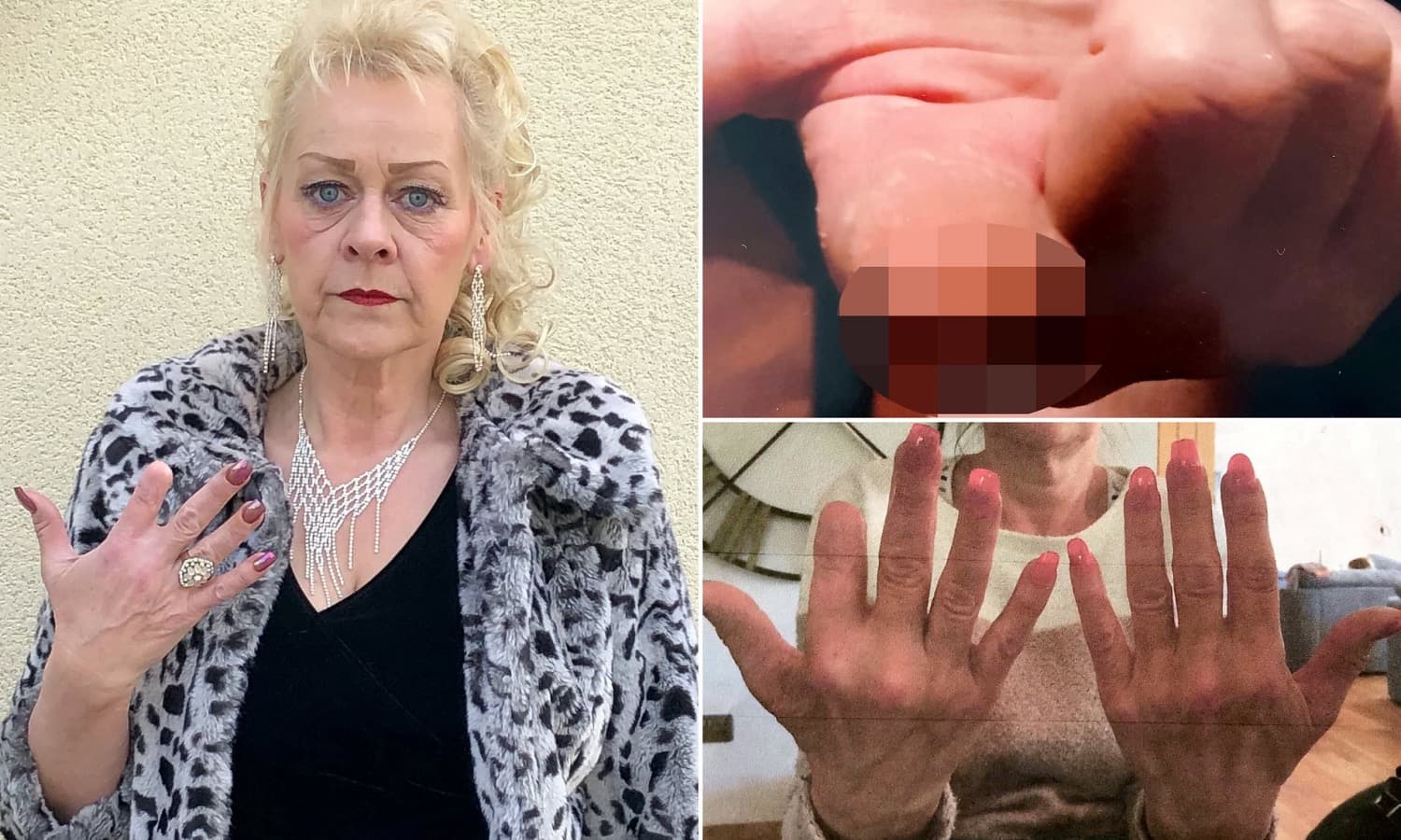 MEGDÖBBENTŐ: A műkörmös hanyagsága miatt kellett amputálni egy nő ujját!