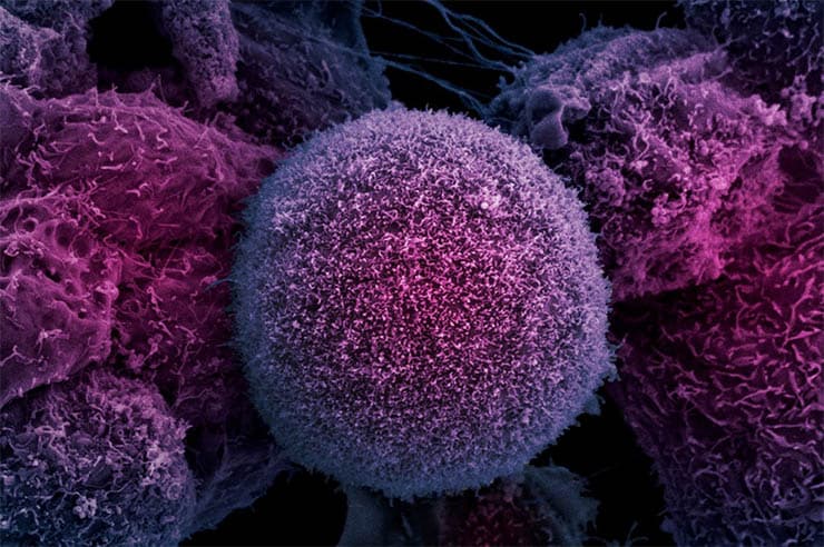 Egy gén "lecsendesítésével" állították meg a rák terjedését kutatók