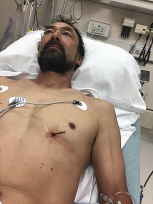 ELKÉPESZTŐ: 9 centis szöggel a mellkasában sétált be a kórházba egy férfi