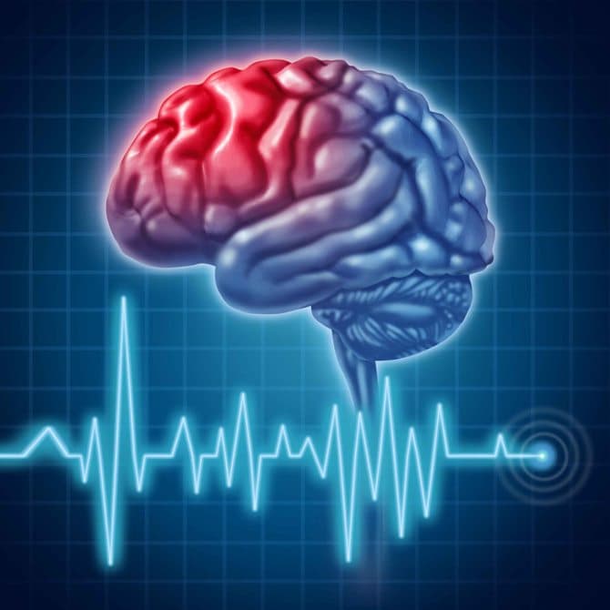 Új terápiás utat nyithat az agyi infarktus kezelésében magyar kutatók felfedezése